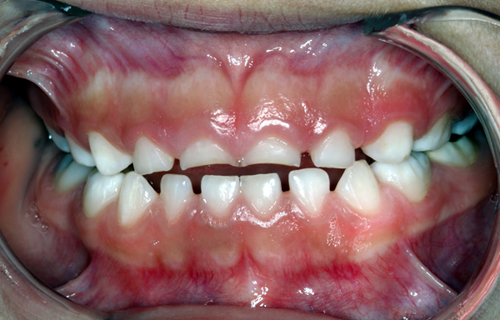 The decicuous dentition contains only primary teeth.